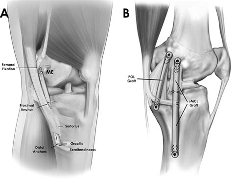 Mer graft for acl reconstruction